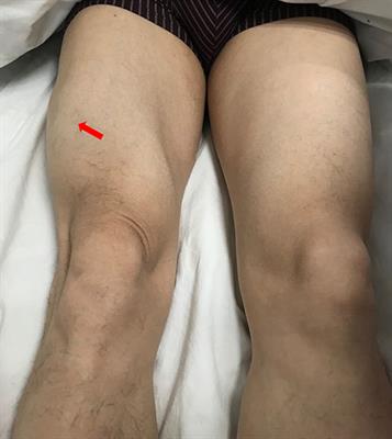 Muscular Tuberculosis: A New Case and a Review of the Literature